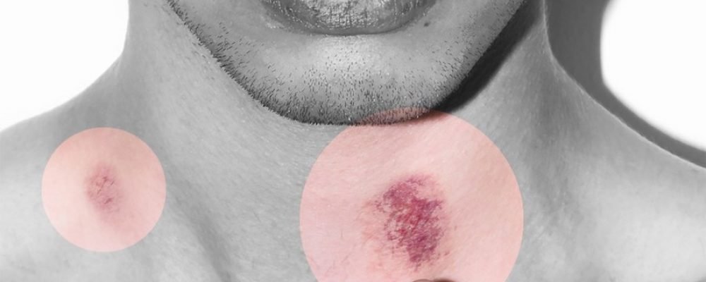 Cómo quitarte un chupetón, si de alguna manera los sigues recibiendo